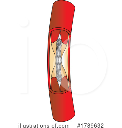 Royalty-Free (RF) Stent Clipart Illustration by Lal Perera - Stock Sample #1789632